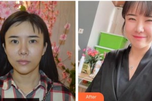 黃石市中心醫(yī)院整形外科陳杰整形價(jià)格表附埋線提升案例展示