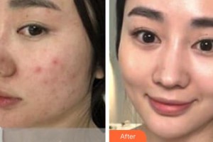 黃石華中?？滇t(yī)院（華中.華美）張智珍整形價(jià)格表附黃金微針案例展示