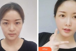 黃石華中?？滇t(yī)院（華中.華美）曹英武整形價(jià)格表附埋線提升案例展示