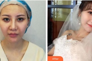 黃石市第五醫(yī)院整形外科陳正華整形價(jià)格表附埋線提升案例展示