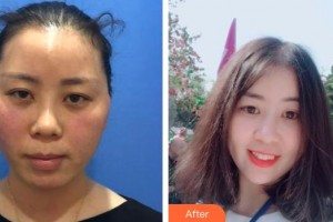 黃石美亞醫(yī)療美容門診部張明雙整形價(jià)格表附埋線提升案例展示