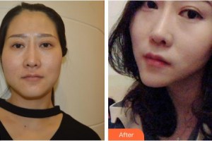 黃石美亞醫(yī)療美容門(mén)診部王幼明整形價(jià)格表附激光美膚激光案例展示