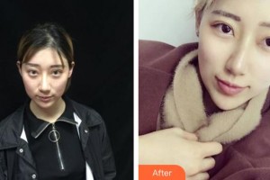 黃石華中?？滇t(yī)院（華中.華美）余秋芬整形價(jià)格表附埋線(xiàn)提升案例展示