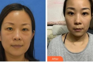 黃石愛(ài)爾眼科醫(yī)院喻杰整形價(jià)格表附激光去眼袋案例展示