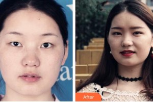 黃石愛(ài)爾眼科醫(yī)院汪建整形價(jià)格表附切開(kāi)雙眼皮案例展示