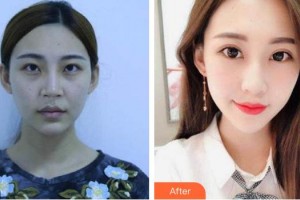 黃石愛爾眼科醫(yī)院陳洋整形價(jià)格表附內(nèi)切祛眼袋案例展示