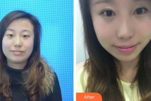 黃石愛爾眼科醫(yī)院吳海政整形價(jià)格表附眼部綜合案例展示