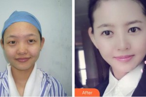 黃石愛(ài)爾眼科醫(yī)院程國(guó)旺整形價(jià)格表附眼部綜合案例展示