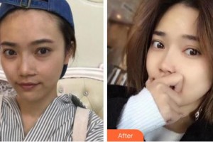 黃石愛爾眼科醫(yī)院朱劍整形價(jià)格表附內(nèi)切祛眼袋案例展示