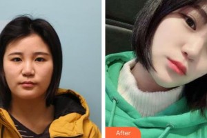 黃石愛爾眼科醫(yī)院葉明整形價(jià)格表附埋線雙眼皮案例展示