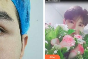 黃石愛爾眼科醫(yī)院柯國(guó)梁整形價(jià)格表附眼部綜合案例展示