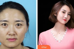 黃石愛爾眼科醫(yī)院吳湘整形價(jià)格表附切開雙眼皮案例展示