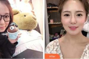 黃石中山口腔醫(yī)院曹先利整形價(jià)格表附金屬托槽矯正案例展示