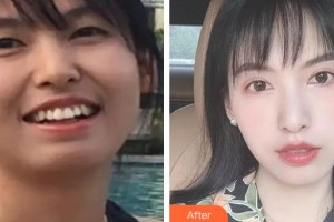 黃石現(xiàn)代口腔醫(yī)院李蒙整形價(jià)格表附金屬托槽矯正案例展示