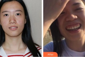 黃石中山口腔醫(yī)院馮濤整形價(jià)格表附隱形托槽矯正案例展示