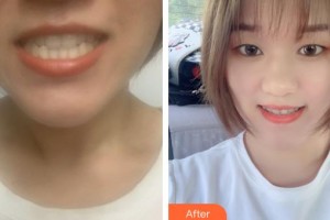 黃石春天口腔門診部宮小成整形價(jià)格表附牙齒隱形矯正案例展示