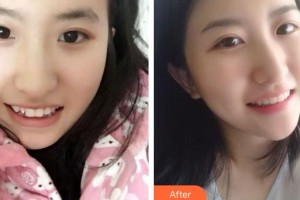 黃石春天口腔門診部劉春林整形價(jià)格表附牙齒隱形矯正案例展示