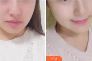 十堰梵媞醫(yī)學美容門診部余琴整形價格表附埋線提升案例展示