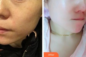 十堰阿芙羅醫(yī)療整形美容門診部陳敬斌整形價格表附激光美膚激光案例展示