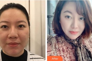 十堰梵媞醫(yī)學美容門診部張琴真整形價格表附埋線提升案例展示