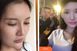 十堰市人民醫(yī)院整形美容燒傷外科王建國(guó)整形價(jià)格表附埋線提升案例展示