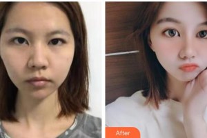 十堰愛爾眼科醫(yī)院張青松整形價(jià)格表附熱拉提案例展示