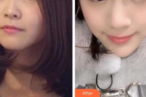 十堰市人民醫(yī)院整形美容燒傷外科王鵬整形價(jià)格表附熱拉提案例展示