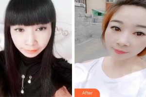 十堰愛爾眼科醫(yī)院李凌整形價(jià)格表附切眉術(shù)案例展示