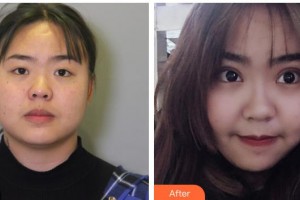 十堰愛爾眼科醫(yī)院張守奇整形價格表附眼部綜合案例展示