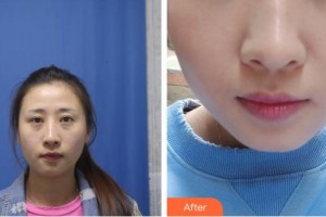 十堰愛爾眼科醫(yī)院李儒華整形價(jià)格表附切開雙眼皮案例展示