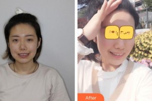 十堰東風(fēng)口腔醫(yī)院龍明生整形價(jià)格表附牙齒隱形矯正案例展示