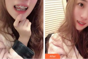 十堰東風(fēng)口腔醫(yī)院李守宏整形價(jià)格表附金屬托槽矯正案例展示