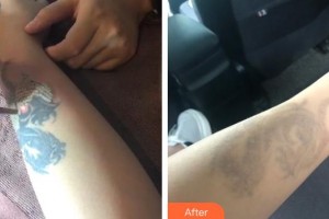 襄陽市中心醫(yī)院整形美容科胡強整形價格表附激光去紋身案例展示