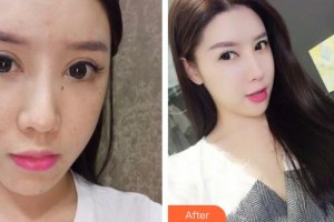 襄陽市中心醫(yī)院整形美容科姚春蓮整形價格表附激光祛斑案例展示