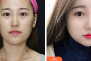 襄陽美嘉伊整形美容醫(yī)院陳明亮整形價格表附激光祛斑案例展示