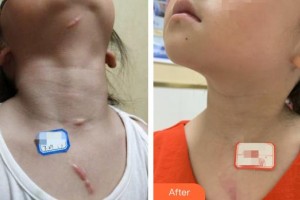 襄陽(yáng)市中心醫(yī)院整形美容科王琦整形價(jià)格表附激光祛疤案例展示