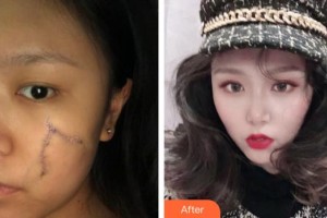 襄陽(yáng)市中心醫(yī)院整形美容科劉丹丹整形價(jià)格表附光子嫩膚案例展示