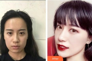 襄陽(yáng)市中心醫(yī)院整形美容科靳軍華整形價(jià)格表附無(wú)針?biāo)獍咐故?>
</a>
<h3 class=