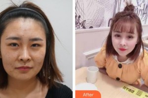 襄陽(yáng)市中心醫(yī)院整形美容科惠祖燕整形價(jià)格表附彩光嫩膚案例展示