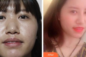 襄陽(yáng)華美醫(yī)療美容門(mén)診部段麗萍整形價(jià)格表附鼻部綜合案例展示