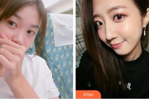 襄陽(yáng)海峽醫(yī)療美容門(mén)診部郭永軍整形價(jià)格表附鼻部綜合案例展示