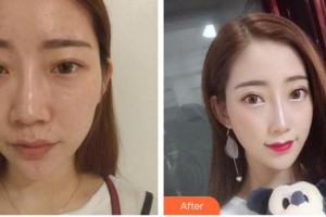 襄陽(yáng)華美醫(yī)療美容門(mén)診部張輝整形價(jià)格表附假體隆鼻案例展示