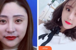 襄陽(yáng)維多利亞醫(yī)療美容醫(yī)院曹仁昌整形價(jià)格表附鼻部綜合案例展示