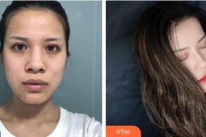 襄陽海峽醫(yī)療美容門診部劉劍整形價格表附鼻部綜合案例展示