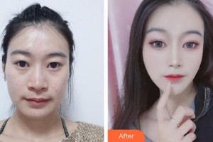 襄陽伊萊美醫(yī)療美容醫(yī)院鄭東學整形價格表附鼻部綜合案例展示