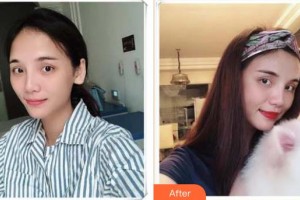 襄陽(yáng)韓蔻醫(yī)療美容門診部卞丹整形價(jià)格表附自體脂肪填充額頭案例展示