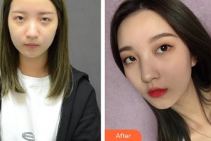 襄陽(yáng)美嘉伊整形美容醫(yī)院馬行整形價(jià)格表附自體脂肪全臉填充案例展示