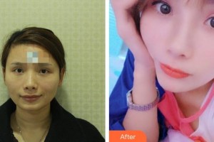 襄陽悅美醫(yī)療美容門診部吳學陽整形價格表附自體脂肪填充蘋果肌案例展示