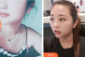 襄陽伊爾美整形美容醫(yī)院王光雪整形價格表附熱拉提案例展示