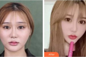 襄陽美嘉伊整形美容醫(yī)院鄭明哲整形價格表附埋線提升案例展示